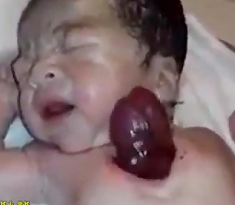 نوزاد با قلب بیرون از سینه