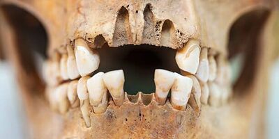 کشف براده‌های دندان عجیب و غریب در جزیره گوتلند بالتیک / تکنولوژی جالب وایکینگ‌ها در درمان دندان هایشان