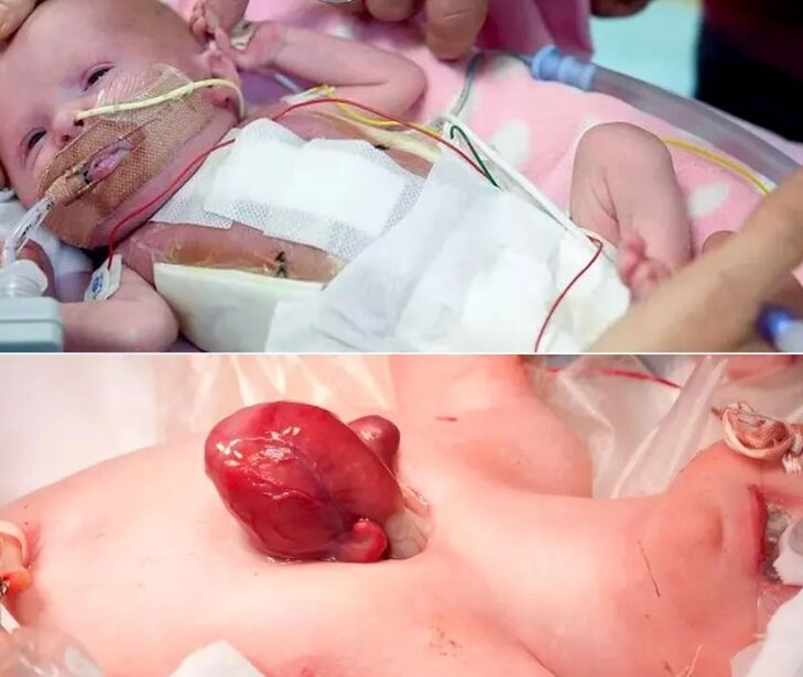 نوزاد با قلب بیرون از بدن